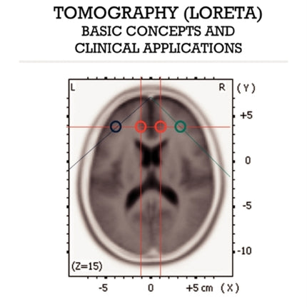 Low Resolution Brain Electromagnetic Tomography