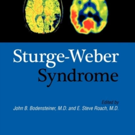 SturgeWeber Syndrome