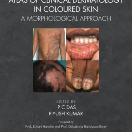 Atlas of Clinical Dermatology in Coloured Skin: A Morphological Approach