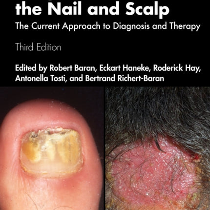 Fungal Infections of the Nail and Scalp