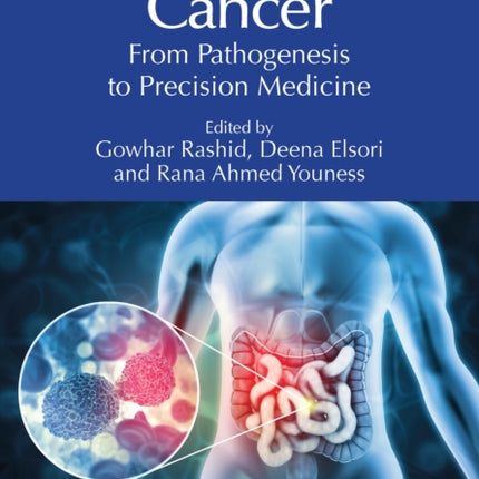 Colorectal Cancer