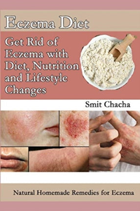 Eczema Diet  Get Rid of Eczema with Diet Nutrition and Lifestyle Changes