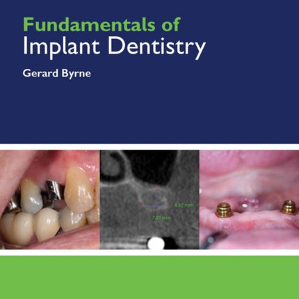 Fundamentals of Implant Dentistry