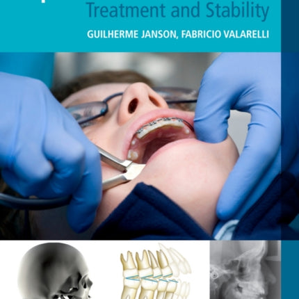 OpenBite Malocclusion