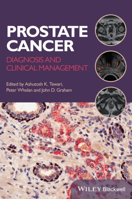 Prostate Cancer: Diagnosis and Clinical Management