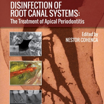 Disinfection of Root Canal Systems