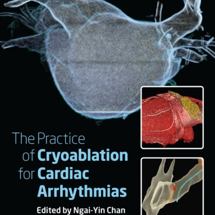 The Practice of Catheter Cryoablation for Cardiac Arrhythmias