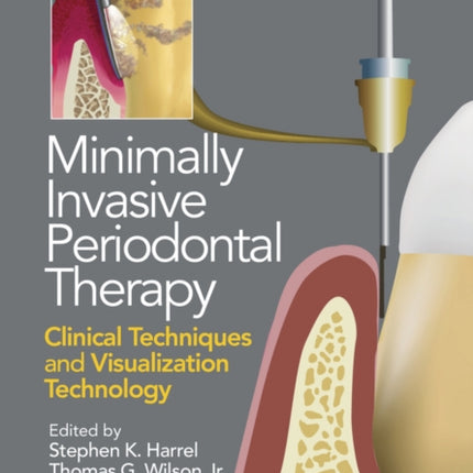 Minimally Invasive Periodontal Therapy: Clinical Techniques and Visualization Technology