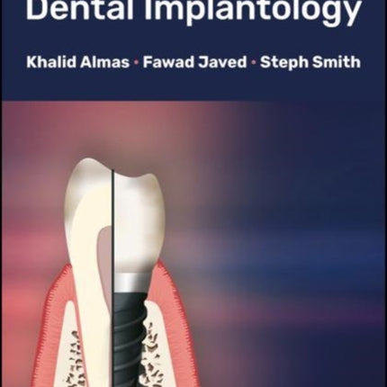 Glossary of Dental Implantology