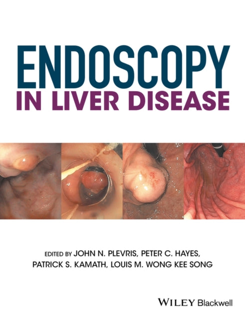 Endoscopy in Liver Disease