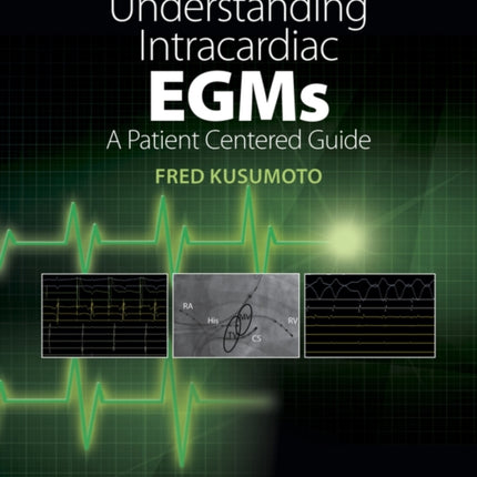 Understanding Intracardiac EGMs: A Patient Centered Guide