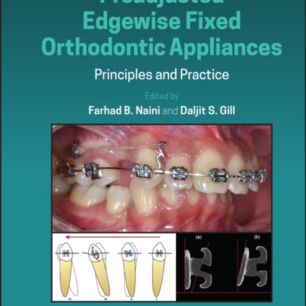 Preadjusted Edgewise Fixed Orthodontic Appliances: Principles and Practice