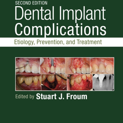 Dental Implant Complications: Etiology, Prevention, and Treatment