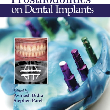 Journal of Prosthodontics on Dental Implants