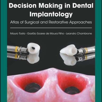 Decision Making in Dental Implantology