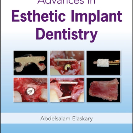 Advances in Esthetic Implant Dentistry