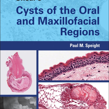 Shear's Cysts of the Oral and Maxillofacial Regions