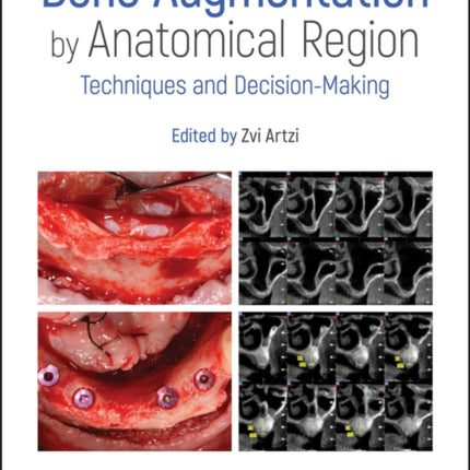 Bone Augmentation by Anatomical Region: Techniques and Decision-Making