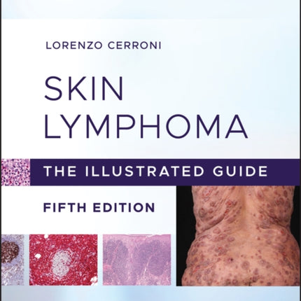 Skin Lymphoma: The Illustrated Guide