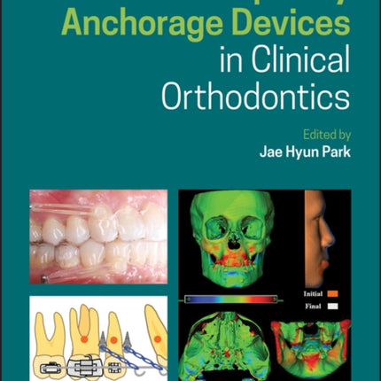 Temporary Anchorage Devices in Clinical Orthodontics