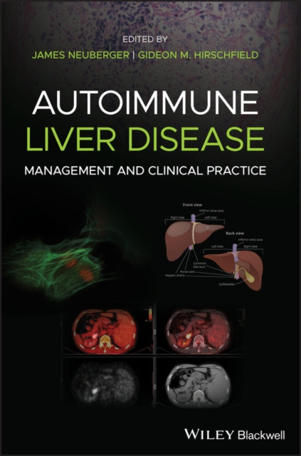 Autoimmune Liver Disease: Management and Clinical Practice