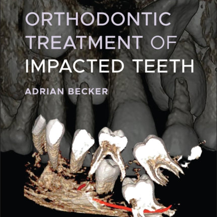 Orthodontic Treatment of Impacted Teeth