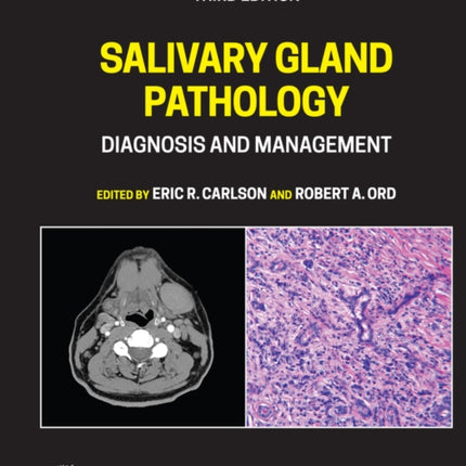 Salivary Gland Pathology: Diagnosis and Management