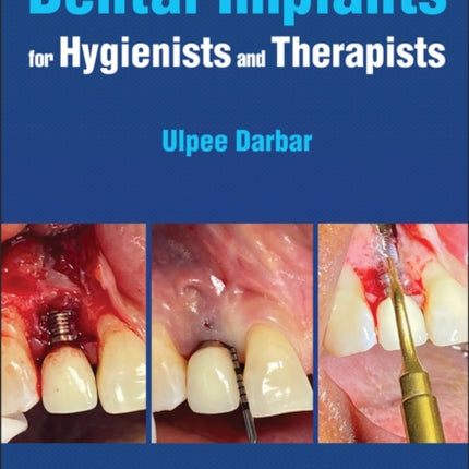 Dental Implants for Hygienists and Therapists