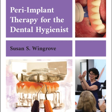 Peri-Implant Therapy for the Dental Hygienist