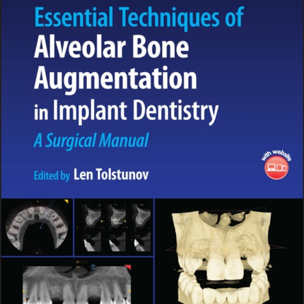 Essential Techniques of Alveolar Bone Augmentation in Implant Dentistry: A Surgical Manual