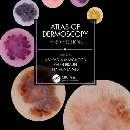 Atlas of Dermoscopy: Third Edition