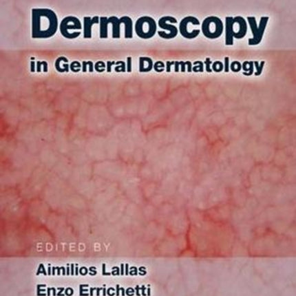 Dermoscopy in General Dermatology