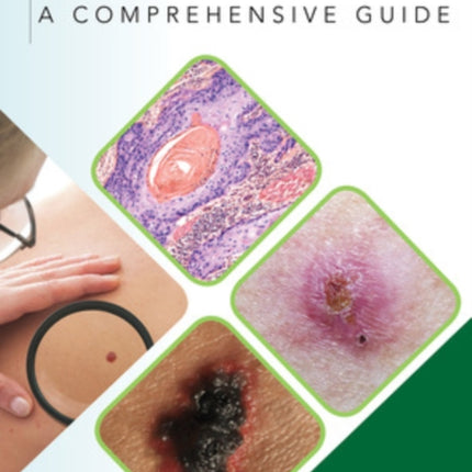 Skin Cancer: A Comprehensive Guide