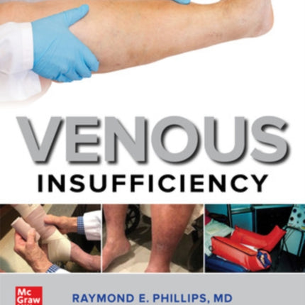 Venous Insufficiency