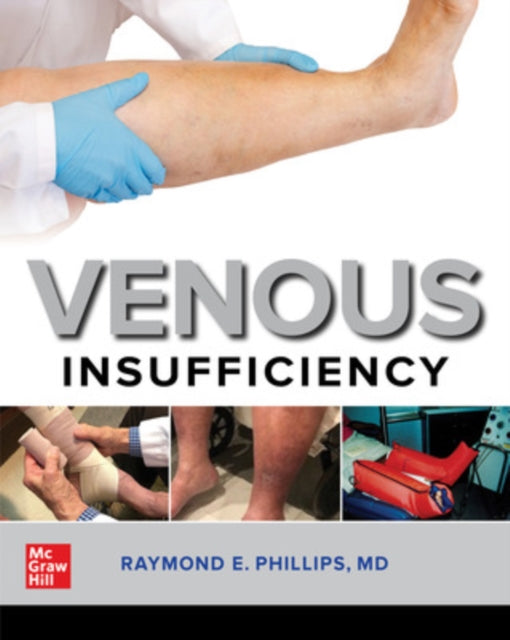 Venous Insufficiency