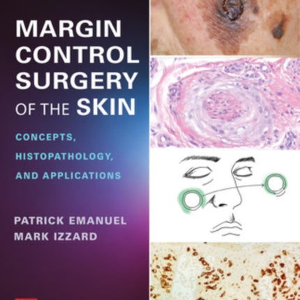 Margin Control Surgery of the Skin: Concepts, Histopathology, and Applications