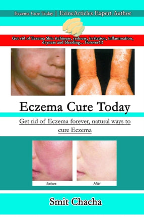 Eczema Cure Today  Get rid of Eczema forever natural ways to cure Eczema