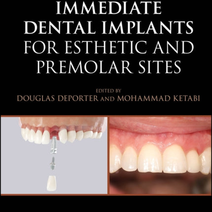 Immediate Dental Implantation Techniques for
