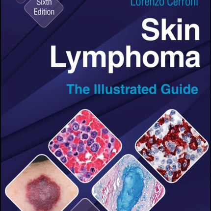 Skin Lymphoma