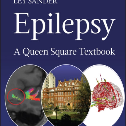 Epilepsy