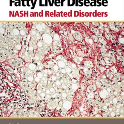 Fatty Liver Disease: NASH and Related Disorders