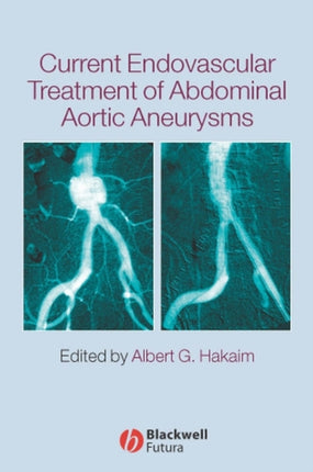 Current Endovascular Treatment of Abdominal