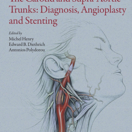 The Carotid and Supra-Aortic Trunks: Diagnosis, Angioplasty and Stenting