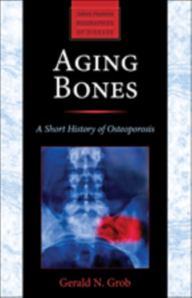 Aging Bones: A Short History of Osteoporosis