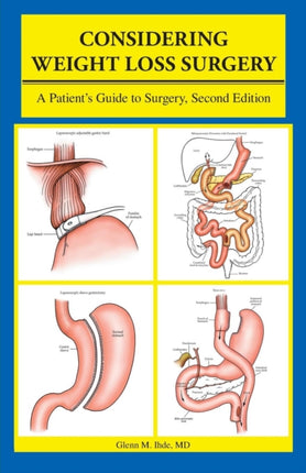 Considering Weight Loss Surgery A Patients Guide to Surgery Second Edition