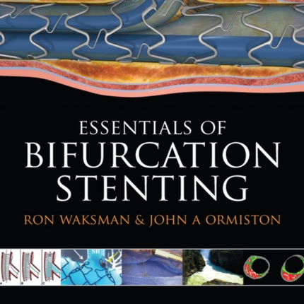 Bifurcation Stenting