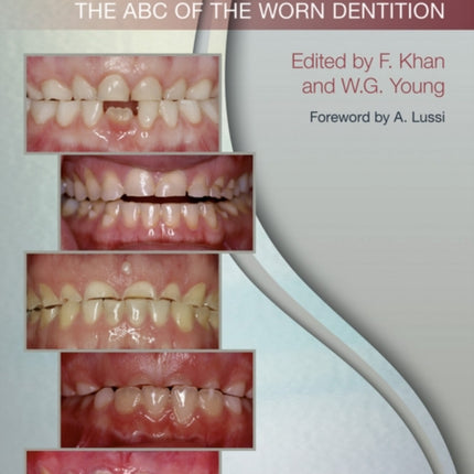 Toothwear: The ABC of the Worn Dentition