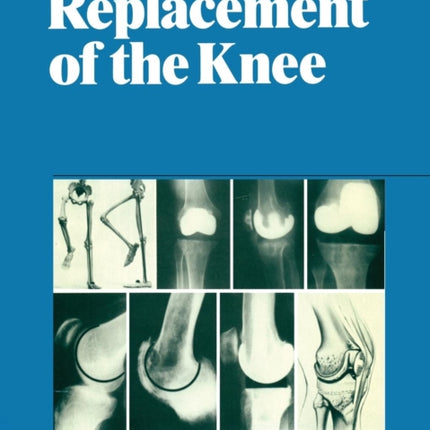 Replacement of the Knee