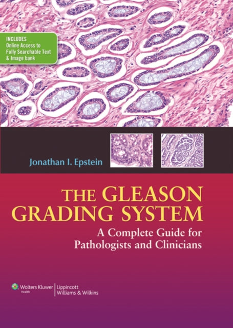 The Gleason Grading System: A Complete Guide for Pathologist and Clinicians