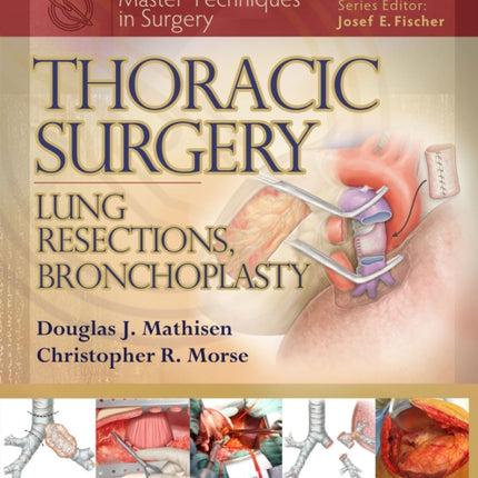 Master Techniques in Surgery: Thoracic Surgery: Lung Resections, Bronchoplasty